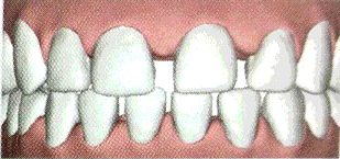 歯と歯の隙間